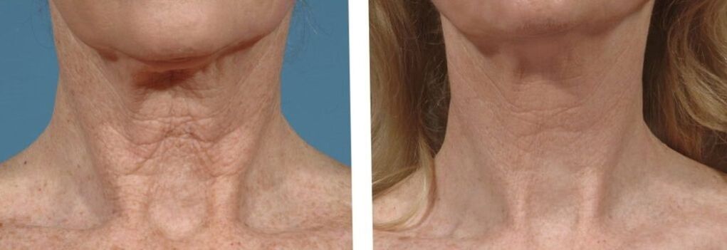 neck skin before and after fractional rejuvenation