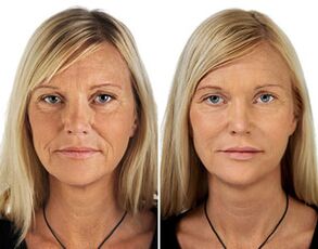 Comparison before and after