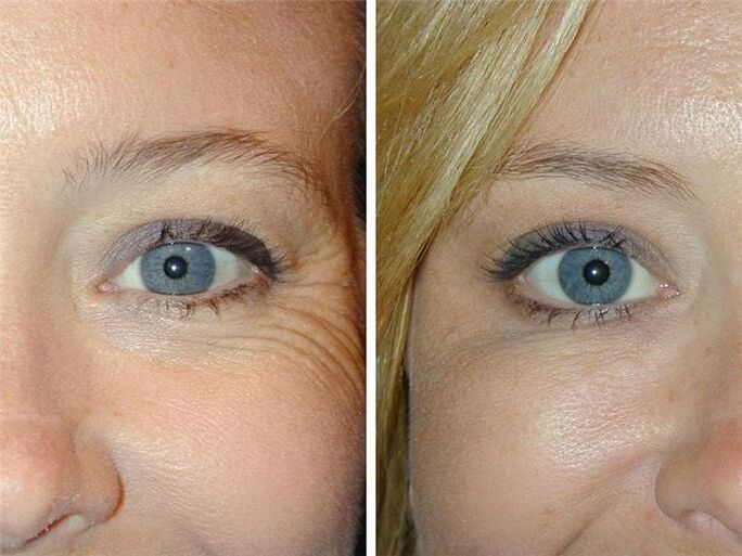 before and after mesotherapy