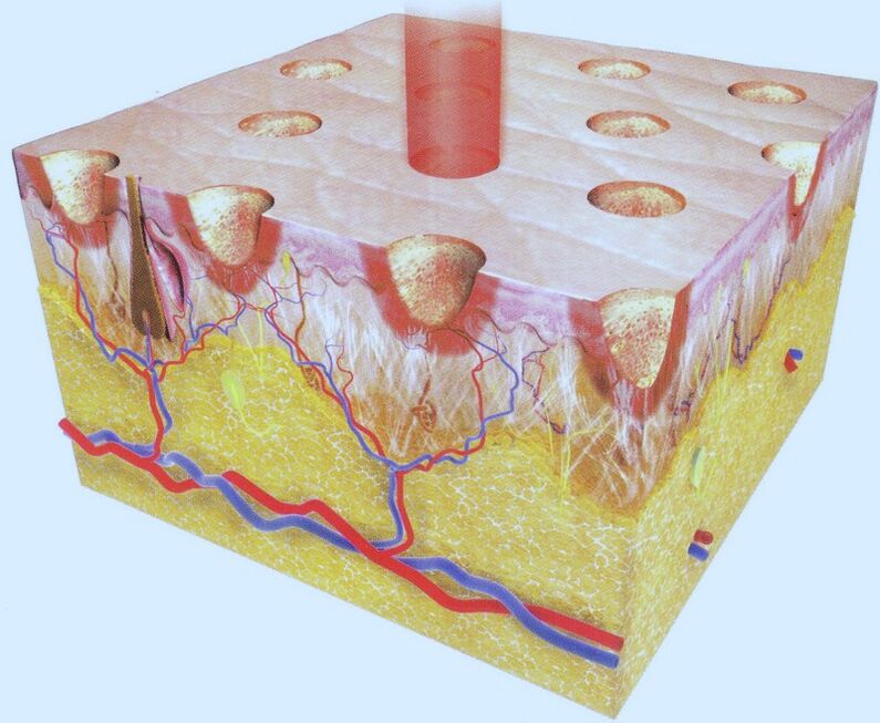 The laser burns out part of the skin cells, forcing their environment to increase regeneration. 