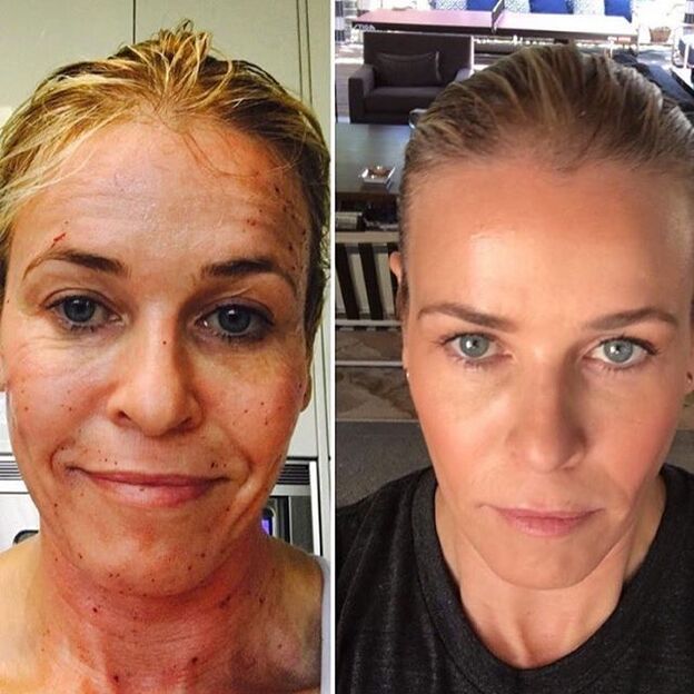 Woman before and after fractional laser (getting rid of hyperpigmentation foci)